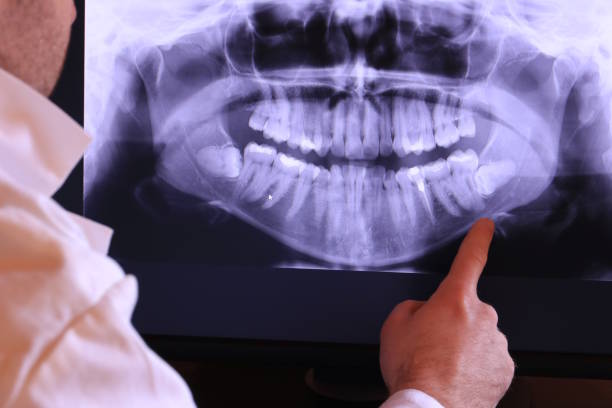 Best Emergency Wisdom Teeth Removal in Burnettown, SC